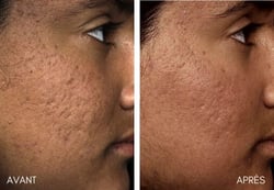 fraxel cicatrice acne